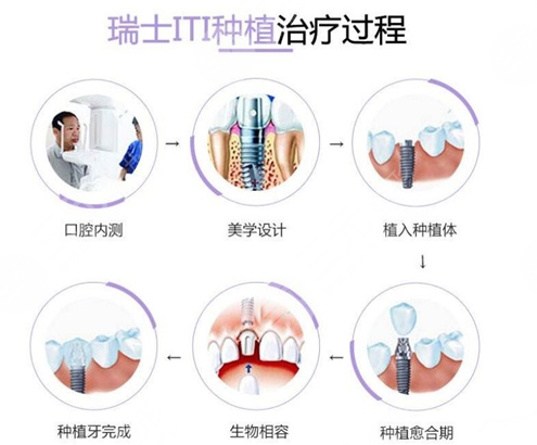 牙齿种植体十大排名榜