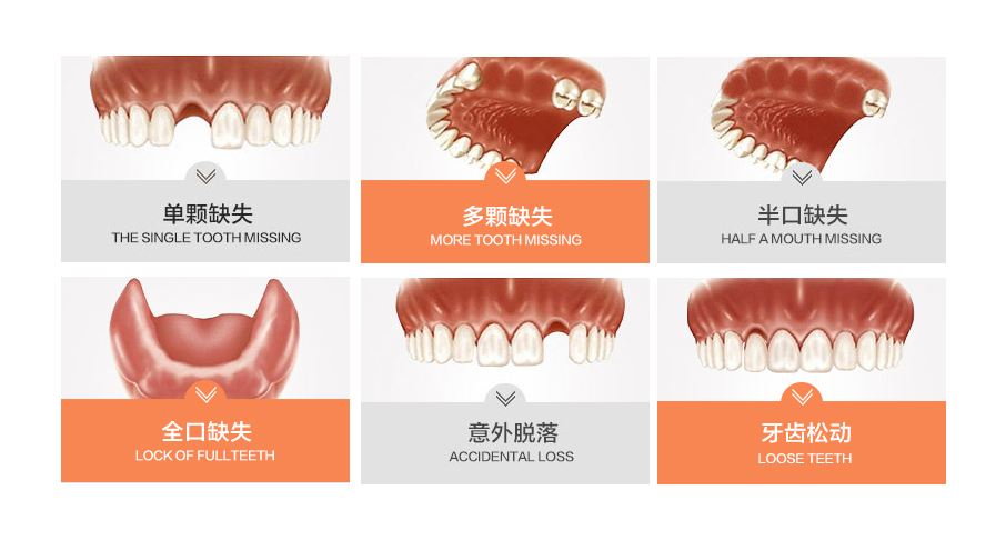 牙齿种植体十大排名榜