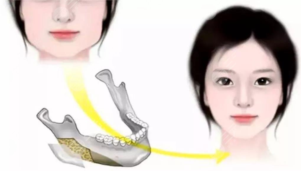  Beijing Badachu Yang Bin Mandibular Angle Surgery