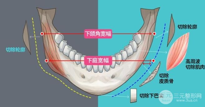 下颌角整形手术价格多少钱