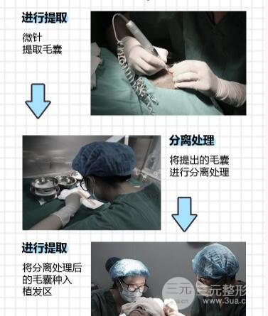  Which is a good regular hospital for hair transplantation in Shenzhen