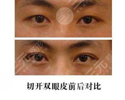  Ranking list of Chongqing double eyelid cutting hospitals