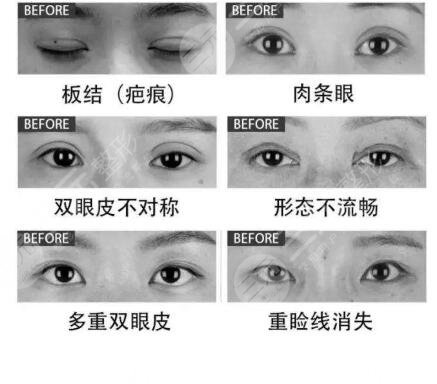  Picture of failed operation of double eyelid