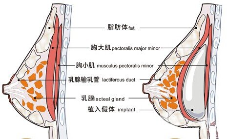  Does prosthetic breast augmentation feel real