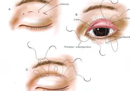  Which doctor is better for double eyelid in South Hospital