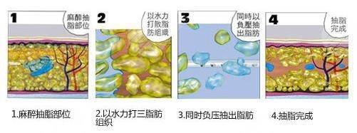  How about a double eyelid operation in the First Affiliated Hospital of Sun Yat sen University