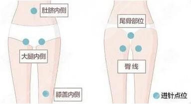  How about the effect of liposuction in Zhongshan People's Hospital