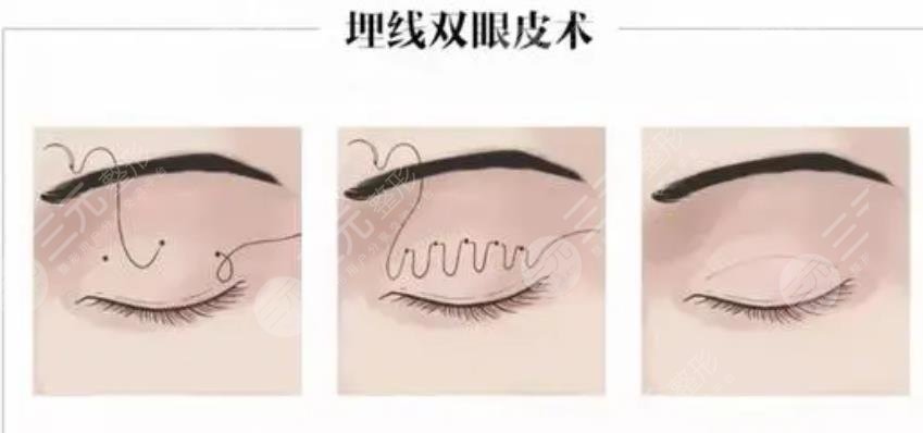  Eight pictures of double eyelid failure