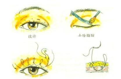  What types of eyes are not suitable for double eyelid