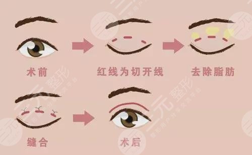  Is the double eyelid dominant or recessive