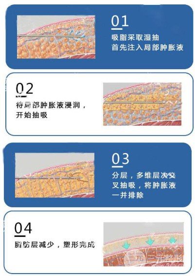  How long is the recovery period of autologous fat filling