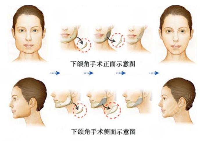  Which hospital is good for mandibular angle grinding in Wuhan