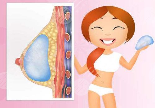  Which is better, fat breast augmentation or prosthesis breast augmentation