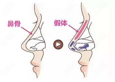 十堰隆鼻技术好的医院公布了鼻综合手术价格