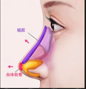  Do you want to take out the prosthesis for augmentation rhinoplasty with white nose tip