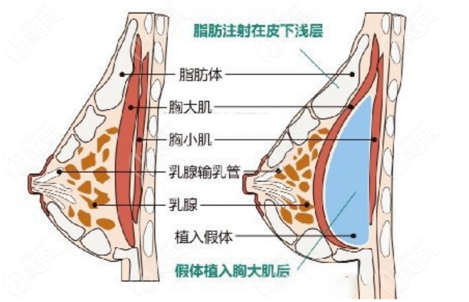  The list of doctors with breast augmentation in Xi'an will be updated in 2022