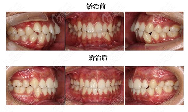  Congratulations to Dr. Wang Huan of Xiamen Malt Oral Cavity on winning the top 50 of the Times Angel Zhimei Invisible Correction Case Contest