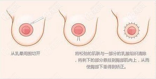  Can I still do double ring suspension surgery more than half a year after completing breast augmentation with prosthesis