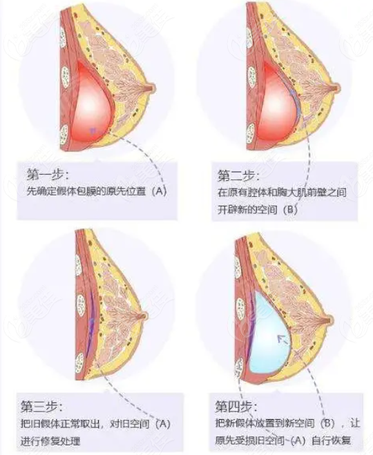 假体隆胸修复是要换假体吗