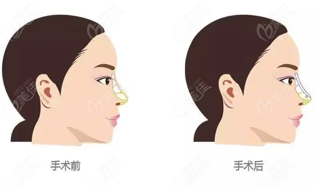  Would you like to know how to improve your nose in Fuzhou Strait