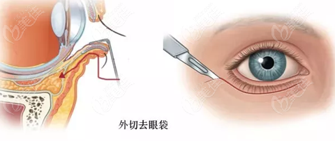  Jixi Eye Bag Dispelling Hospital