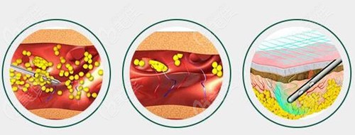  Explain in detail which hospital did a good job of liposuction in Harbin