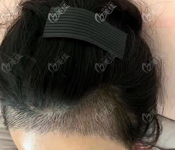  How about hair transplant in Kunming Xinsheng