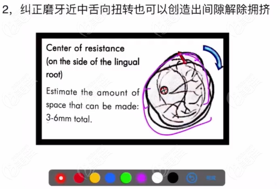 正畸不拔牙也可以内收5-7毫米