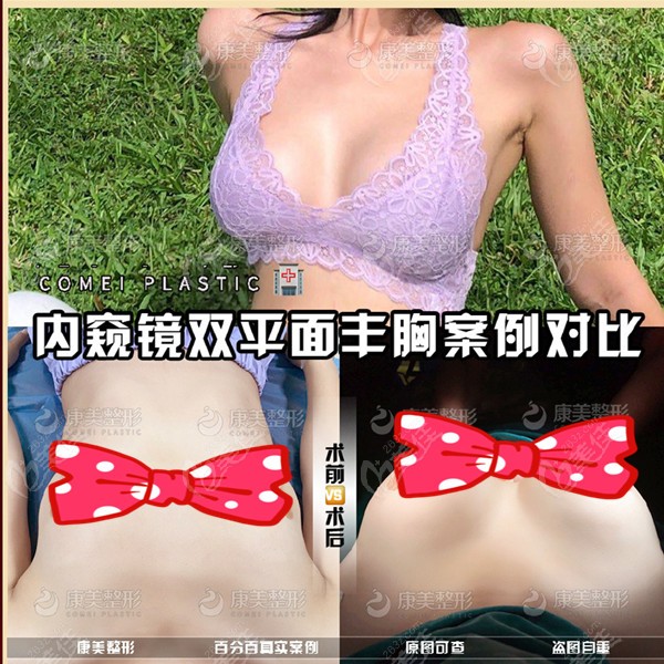  Where in Suzhou has good breast augmentation effect