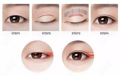  Which hospital in Shijiazhuang is good for double eyelid surgery