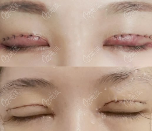  8mm wide double eyelids restoration map