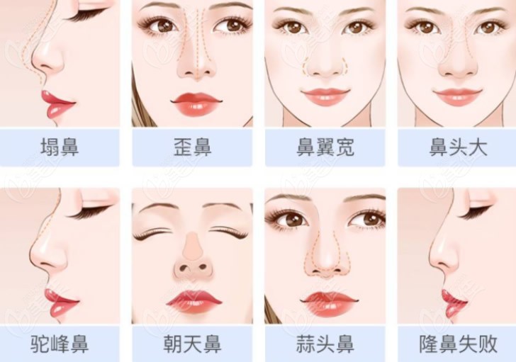  Ranking list of online celebrity nose repair doctors in Shanghai and analysis of the surgical style of doctors such as Fan Rongjie/Li Jian/Wang Yan