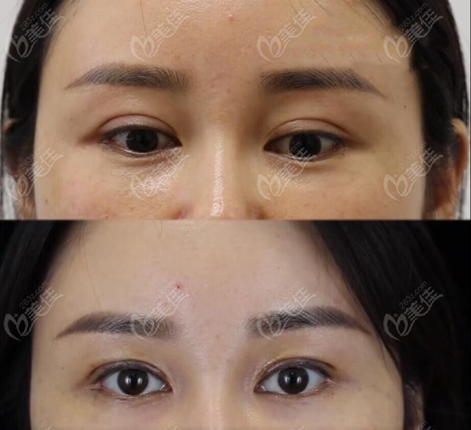  Is Doctor Shi Lili in Beijing good at repairing double eyelid