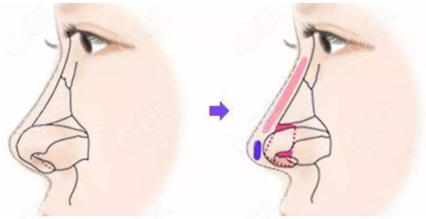  Is nose comprehensive plastic surgery good in Handan Huamei Medical Beauty Hospital