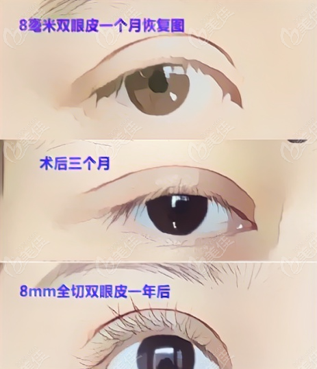  8mm wide double eyelids restoration map