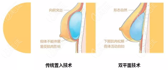  Free breast augmentation recruitment of Cao Mengjun in Shenzhen