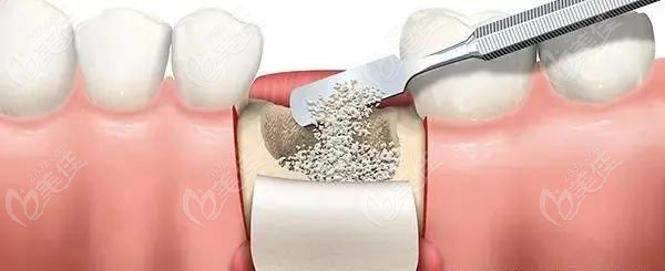  How much is one implant tooth in Jinan Stomatological Hospital