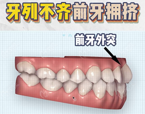 舌侧隐形矫正可以矫治龅牙吗