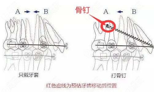 牙齿矫正打支抗钉有啥用啊