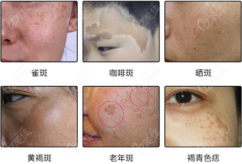  Which hospital has good freckle removal effect in Shanghai