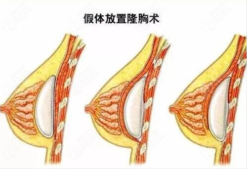  How about Ganzhou Huamei's breast augmentation technique? Please ask Dr. Fang Xiancheng