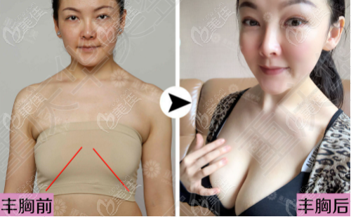  You have to look at Chongqing Huamei for self fat breast augmentation