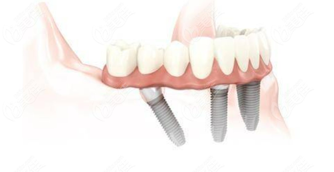  Price list of 2022 dental implant in Nantong