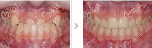 30岁轻微牙性地包天有没有必要矫正