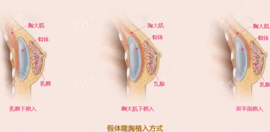 做假体隆胸两年了还能摸到假体