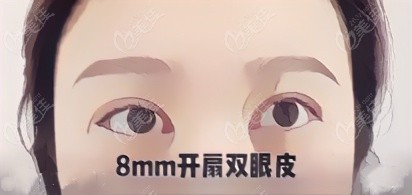  8mm wide double eyelids restoration map