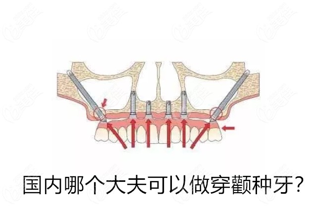 国内哪个大夫可以做穿颧种牙