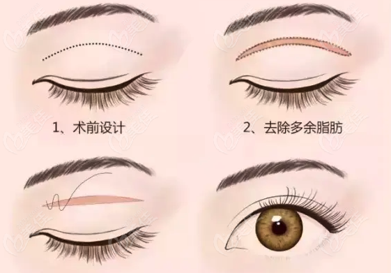  Which company has a good technique of full eyelid removal in Fuzhou