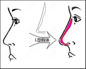  Do you want to take out the prosthesis for augmentation rhinoplasty with white nose tip