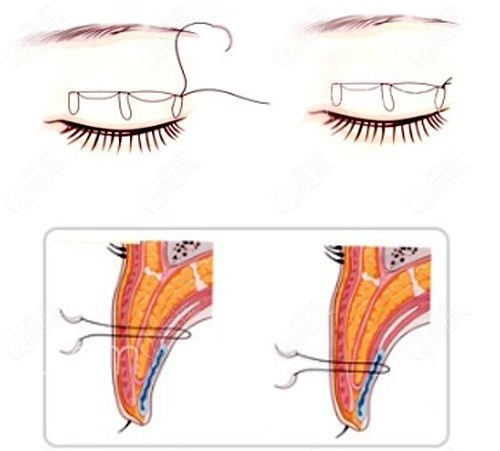  Evaluation of the effect of reconstruction from double eyelid to single eyelid performed by Shin Yung ho from South Korea